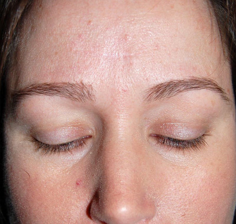 Mohs Forehead Before & After Gallery - Patient 385991 - Image 2