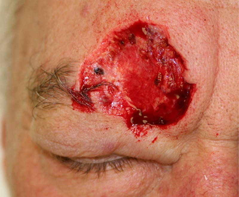 Mohs Forehead Before & After Gallery - Patient 228652 - Image 1