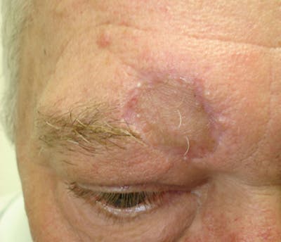 Mohs Forehead Before & After Gallery - Patient 228652 - Image 2