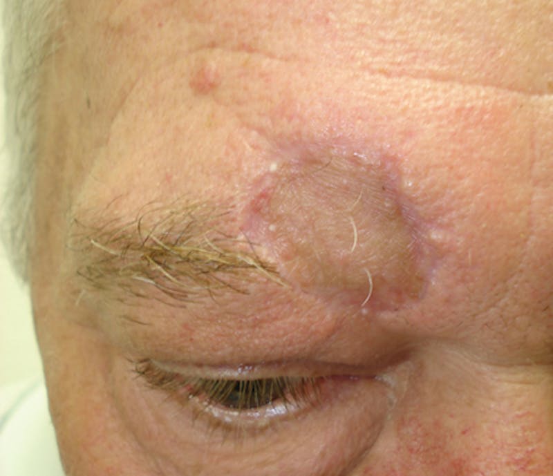 Mohs Forehead Before & After Gallery - Patient 228652 - Image 2