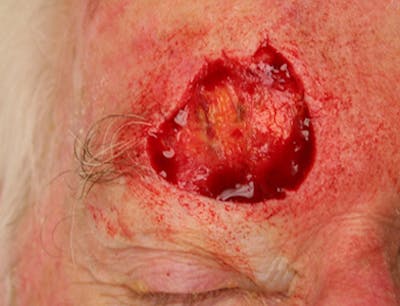 Mohs Forehead Before & After Gallery - Patient 226803 - Image 1
