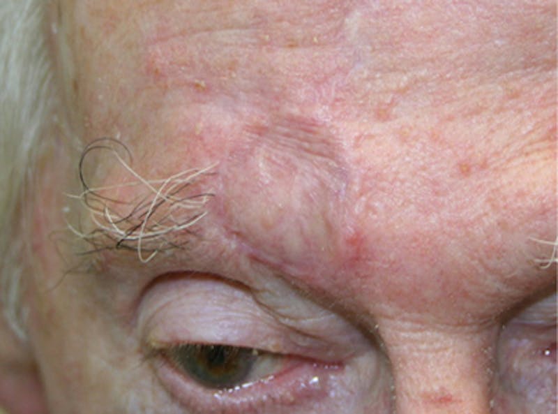 Mohs Forehead Before & After Gallery - Patient 226803 - Image 2