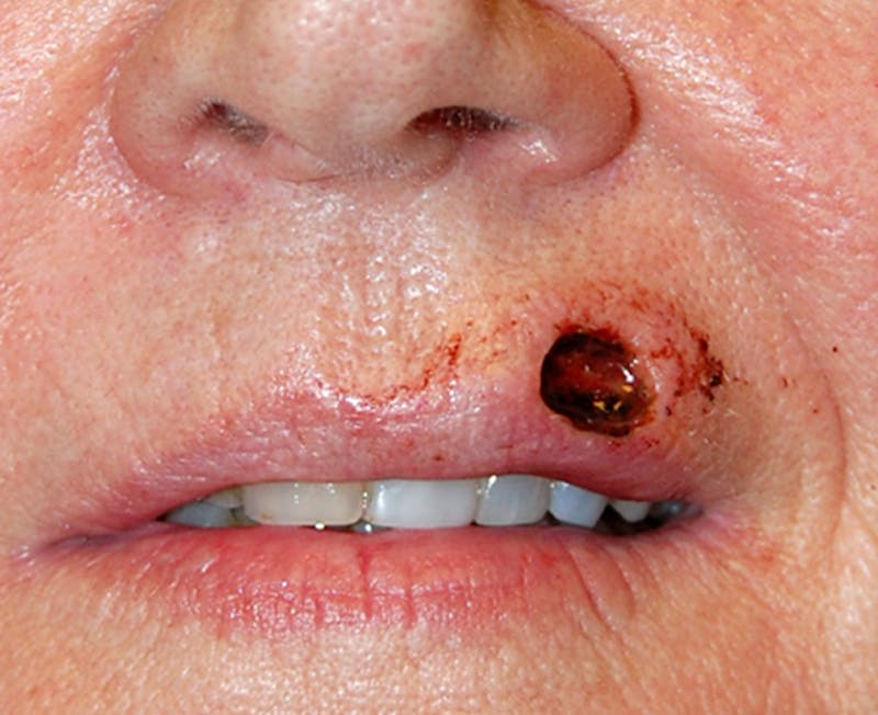 Mohs Lip Before & After Gallery - Patient 169970 - Image 1