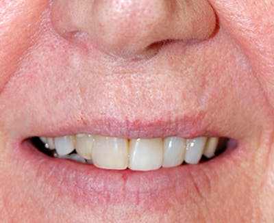 Mohs Lip Before & After Gallery - Patient 169970 - Image 2