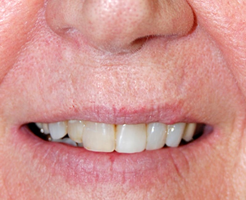 Mohs Lip Before & After Gallery - Patient 169970 - Image 2