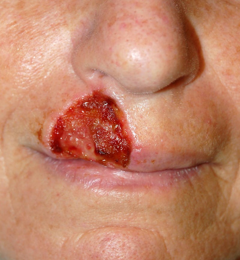 Mohs Lip Before & After Gallery - Patient 353141 - Image 1