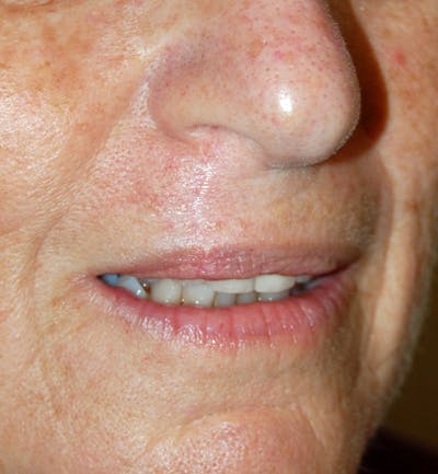 Mohs Lip Before & After Gallery - Patient 353141 - Image 2