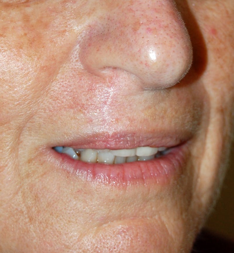 Mohs Lip Before & After Gallery - Patient 353141 - Image 2