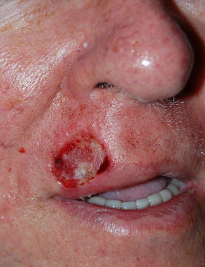 Mohs Lip Before & After Gallery - Patient 190074 - Image 1