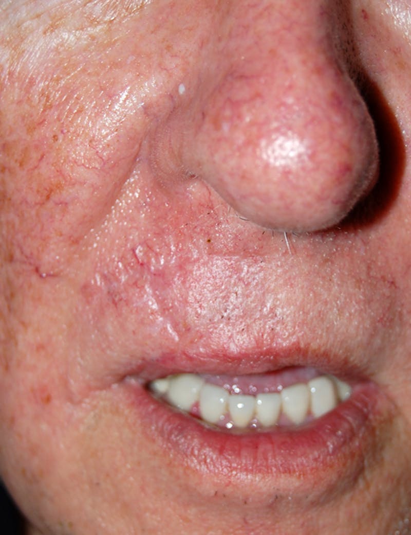 Mohs Lip Before & After Gallery - Patient 190074 - Image 2