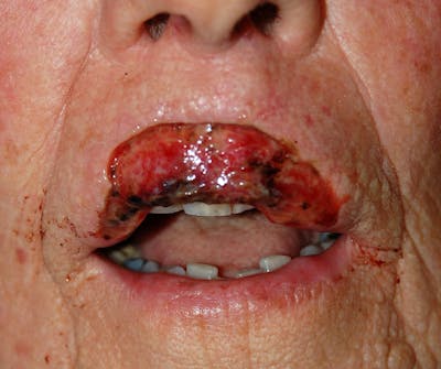 Mohs Lip Before & After Gallery - Patient 343720 - Image 1