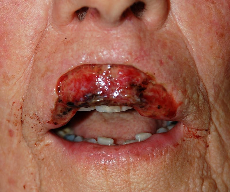Mohs Lip Before & After Gallery - Patient 343720 - Image 1