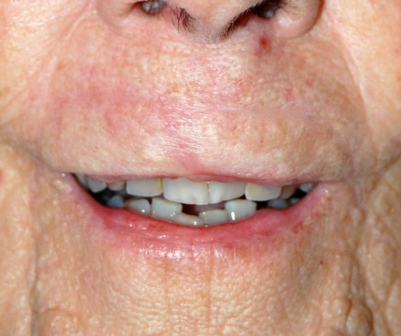 Mohs Lip Before & After Gallery - Patient 343720 - Image 2