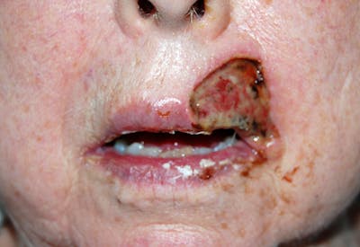 Mohs Lip Before & After Gallery - Patient 284964 - Image 1