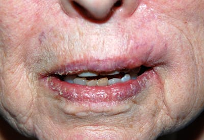 Mohs Lip Before & After Gallery - Patient 284964 - Image 2