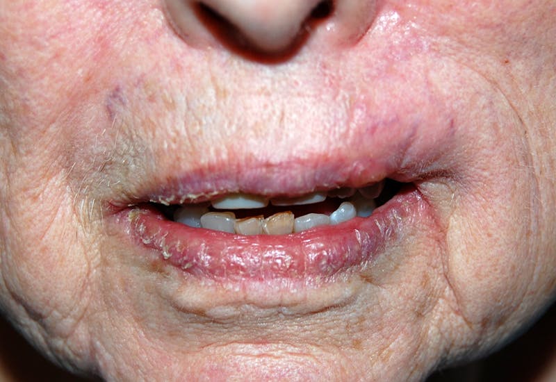 Mohs Lip Before & After Gallery - Patient 284964 - Image 2