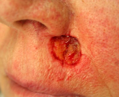 Mohs Lip Before & After Gallery - Patient 341561 - Image 1