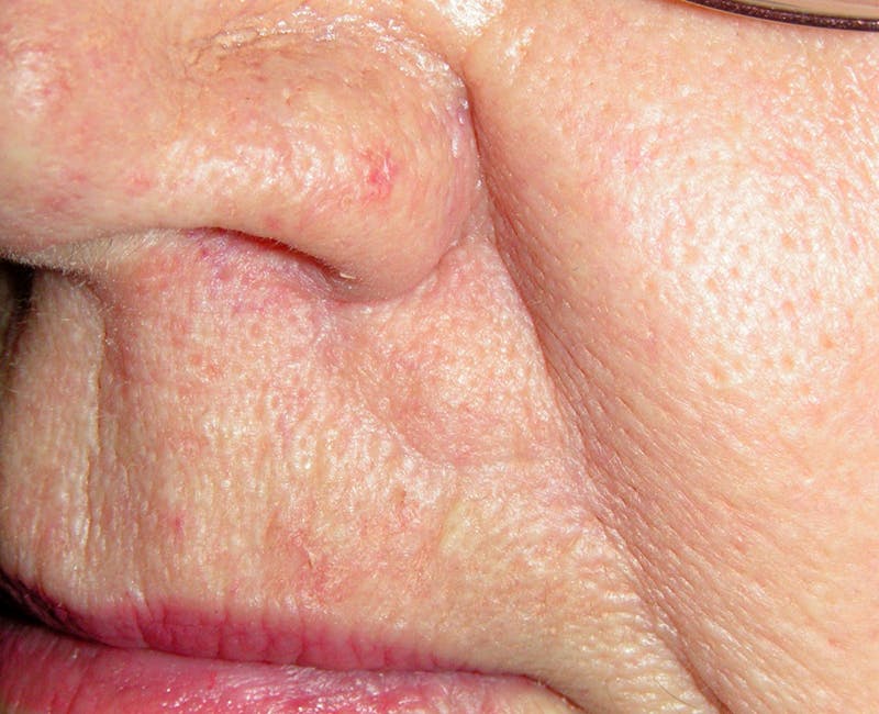 Mohs Lip Before & After Gallery - Patient 341561 - Image 2