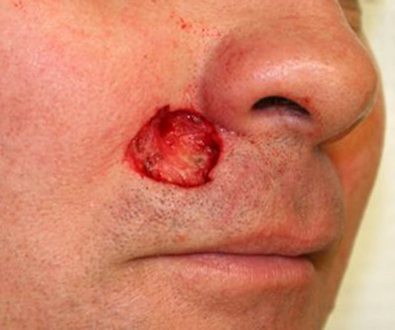 Mohs Lip Before & After Gallery - Patient 231545 - Image 1