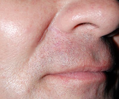 Mohs Lip Before & After Gallery - Patient 231545 - Image 2