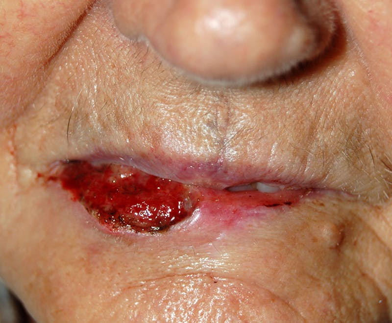 Mohs Lip Before & After Gallery - Patient 287403 - Image 1