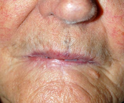Mohs Lip Before & After Gallery - Patient 287403 - Image 2