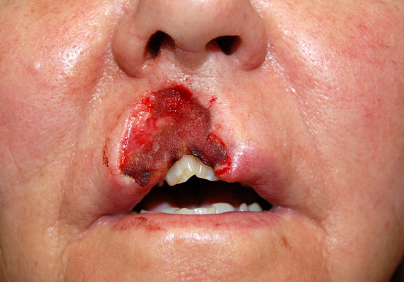 Mohs Lip Before & After Gallery - Patient 326874 - Image 1