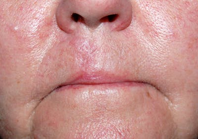 Mohs Lip Before & After Gallery - Patient 326874 - Image 2