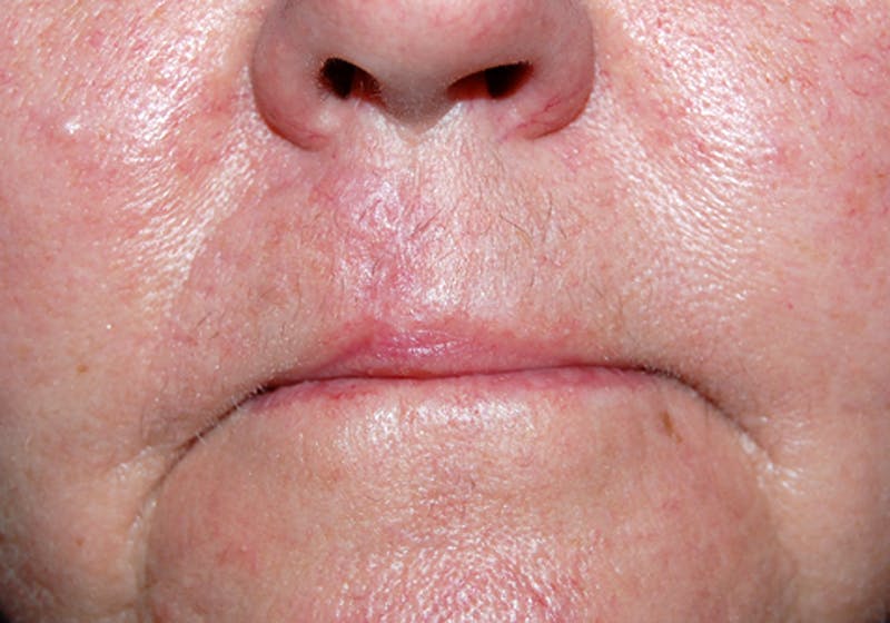 Mohs Lip Before & After Gallery - Patient 326874 - Image 2