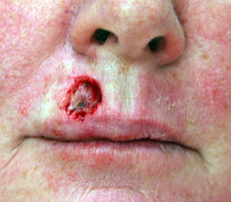 Mohs Lip Before & After Gallery - Patient 701439 - Image 1