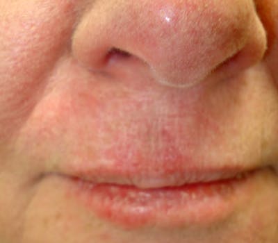 Mohs Lip Before & After Gallery - Patient 701439 - Image 2