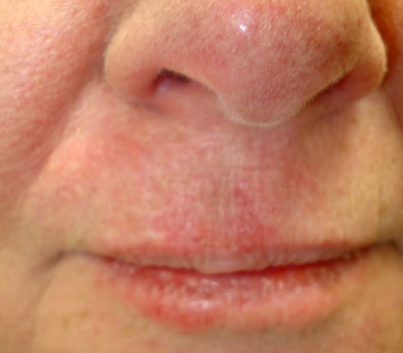 Mohs Lip Before & After Gallery - Patient 701439 - Image 2