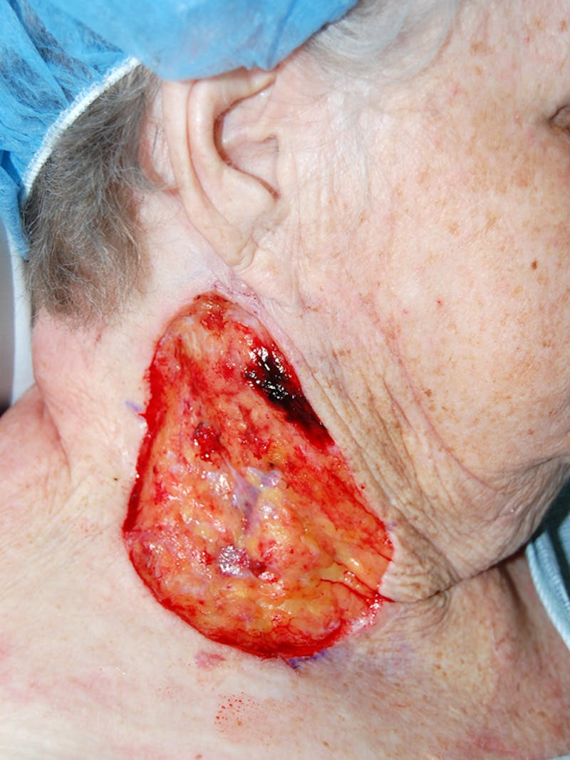 Mohs Neck Before & After Gallery - Patient 149021 - Image 1