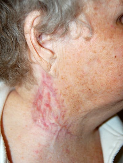 Mohs Neck Before & After Gallery - Patient 149021 - Image 2