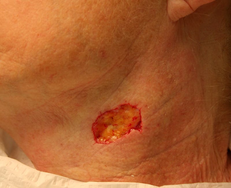 Mohs Neck Before & After Gallery - Patient 210452 - Image 1