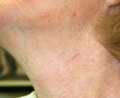 Mohs Neck Before & After Gallery - Patient 210452 - Image 2