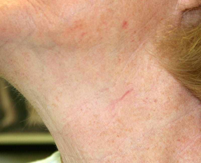 Mohs Neck Before & After Gallery - Patient 210452 - Image 2