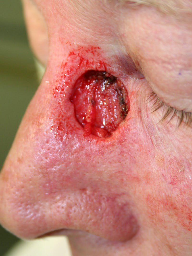 Mohs Nose Before & After Gallery - Patient 302369 - Image 1