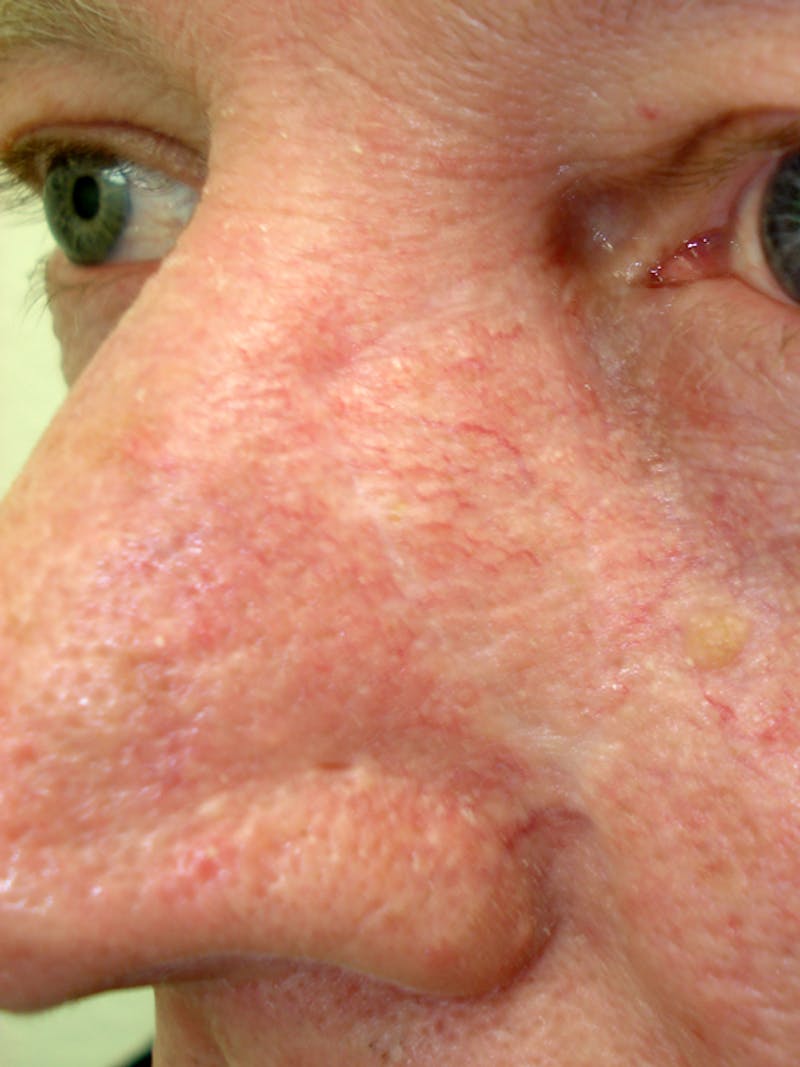 Mohs Nose Before & After Gallery - Patient 302369 - Image 2
