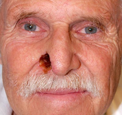 Mohs Nose Before & After Gallery - Patient 459918 - Image 1