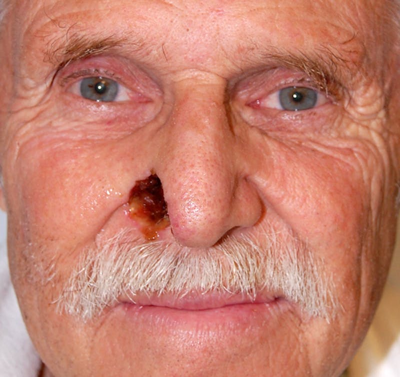Mohs Nose Before & After Gallery - Patient 459918 - Image 1