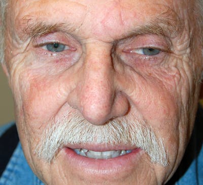 Mohs Nose Before & After Gallery - Patient 459918 - Image 2