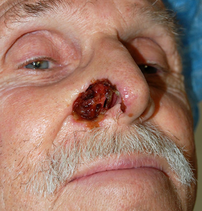Mohs Nose Before & After Gallery - Patient 459918 - Image 3