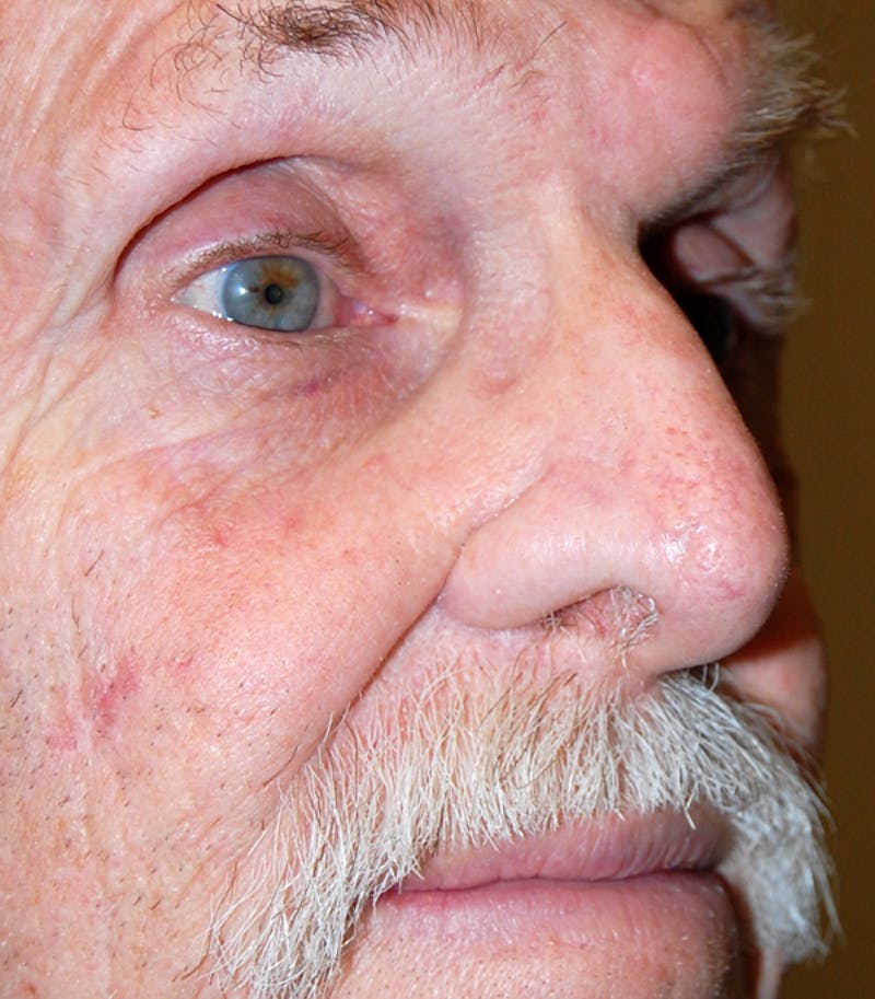 Mohs Nose Before & After Gallery - Patient 459918 - Image 4