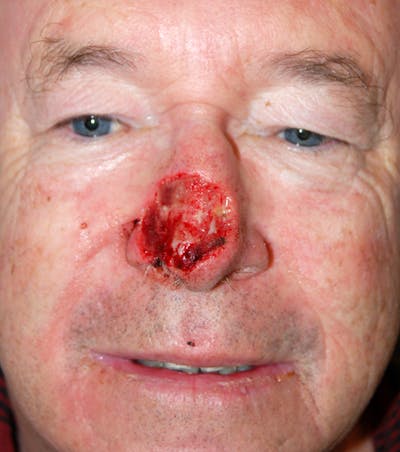 Mohs Nose Before & After Gallery - Patient 151403 - Image 1