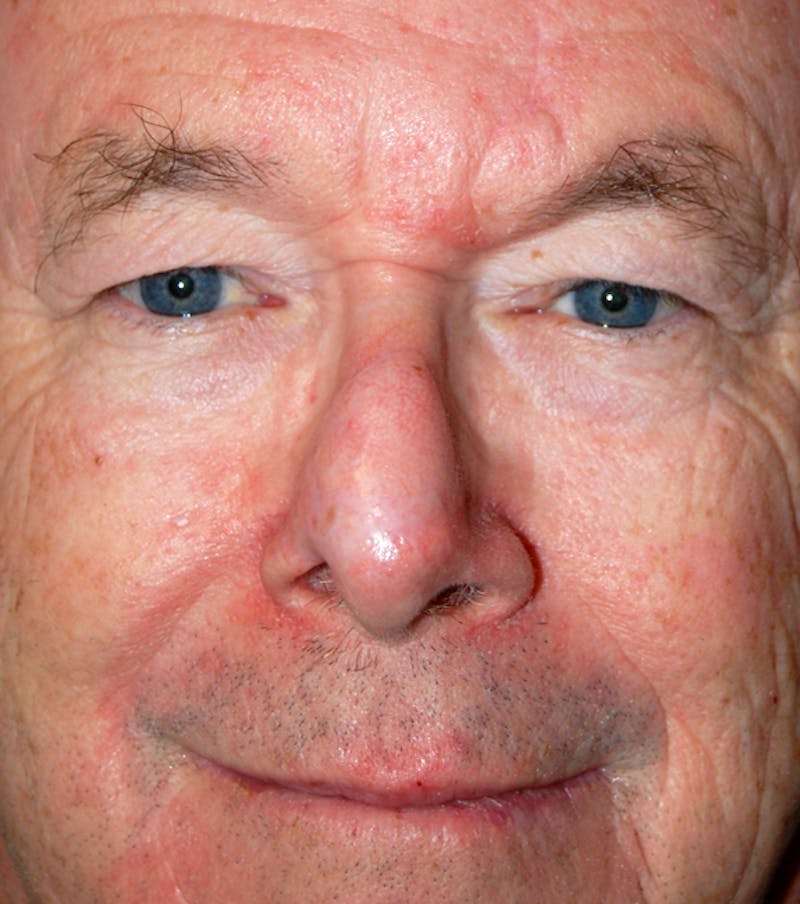 Mohs Nose Before & After Gallery - Patient 151403 - Image 2