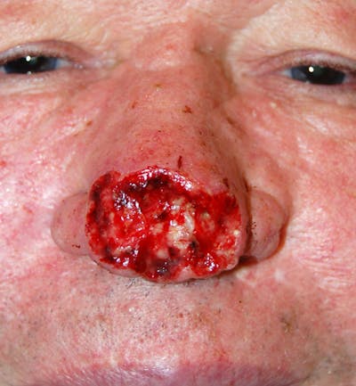 Mohs Nose Before & After Gallery - Patient 197479 - Image 1