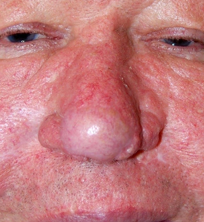 Mohs Nose Before & After Gallery - Patient 197479 - Image 2