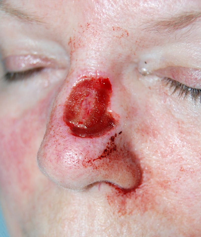 Mohs Nose Before & After Gallery - Patient 692636 - Image 1