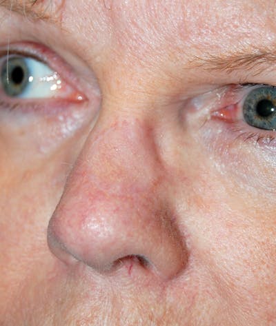 Mohs Nose Before & After Gallery - Patient 692636 - Image 2